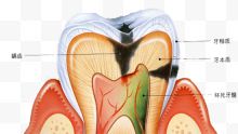 蛀牙原理