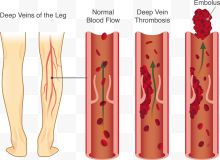 矢量静脉曲张下载