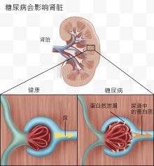 糖尿病会影响肾脏